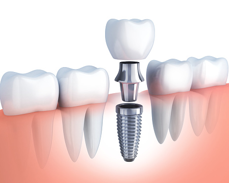 Single tooth implant in row of teeth.